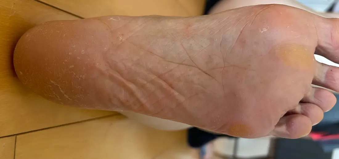 맨발 걷기 후 발 관리 이전 각질과 굳은살 상태